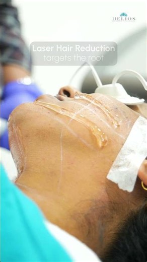 Facial Laser Hair Reduction: Why One Session Is Never Enough #heliosclinic