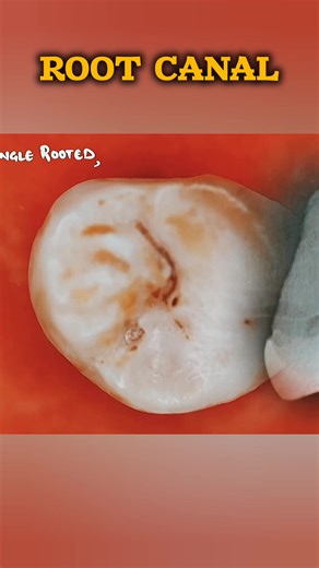 Dental Care Disparities: Extractions vs. Root Canals