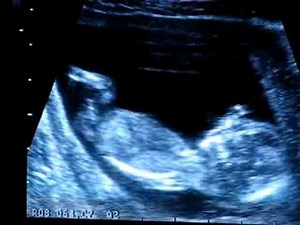 echographie 12 semaines (garcon)