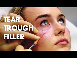 Tear Trough Filler Injections Using Daniel Ezera's Three Point Tangent Technique
