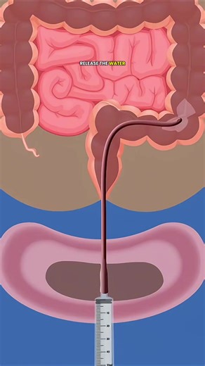 Hirschsprung’s Colitis & Rectal Irrigation Explained 👶 - 3d Animation. #HirschsprungDisease #PediatricSurgery #MedicalEducation #NursingStudents #RectalIrrigation