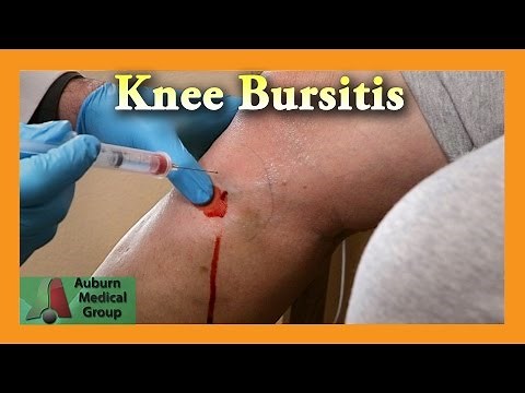 Pes Anserine Bursitis Knee Injection | Auburn Medical Group