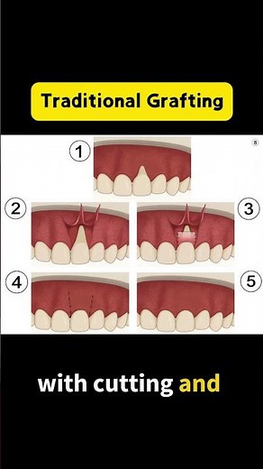Her Smile’s Back: 6 Weeks After Pinhole® for a Single Tooth