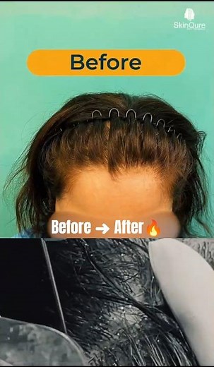 Real Female Hair Transplant Result 🔥 Before & After Transformation | SkinQure