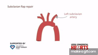 Coarctation of the Aorta: treatment on Make a GIF