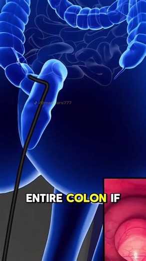 5.7K views · 58 reactions | Colon Polypectomy (3D Animation) #colon #polypectomy #polyp #vessel #precancerous #cancer #electrocautery #abnormal #loop #life #medical3danimation #3dmedicalanimation | Surgery Page | Facebook