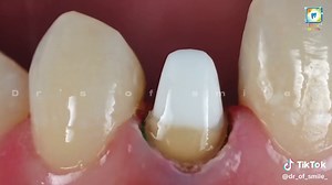 Lateral Incisor Crown Preparation and Lower Incisor RCT Procedure