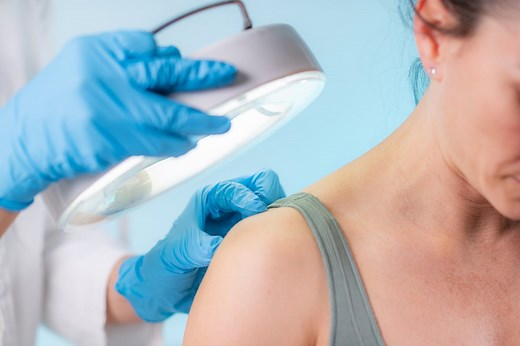 Acrochordon : comment se débarrasser de ces excroissances cutanées ?