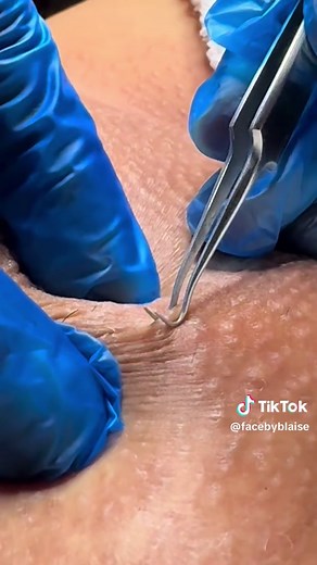 Ingrown Hair Extractions: Expert Techniques and Tips