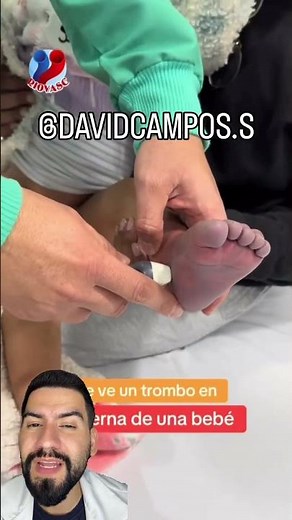 TROMBOSIS EN LA PIERNA