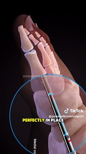 Minimally Invasive Hallux Valgus (Bunion) Surgery #halluxvalgus #bunionsurgery #bunioncorrection #halluxvalgus #halluxvalgustreatment
