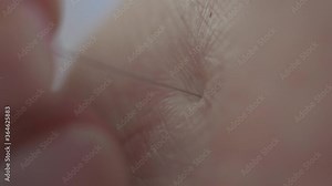 Extreme close-up of acupuncture needle inserted into body. Unrecognizable doctor healing young Caucasian patient using traditional chinese medicine.