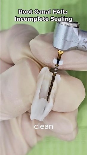 Root Canal Fail - Incomplete Sealing #dentist #dentalcare #oralhealth