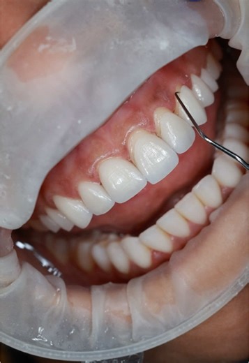Understanding Minimal Prep Veneers for Natural Appearance