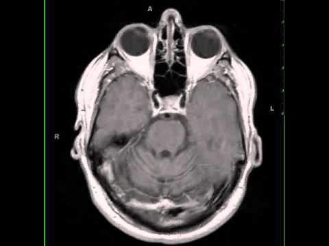 Paraneoplastic Cerebellar Atrophy