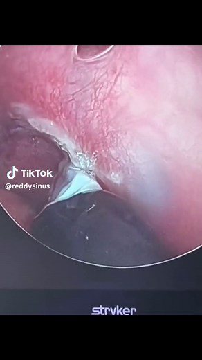 Rhinaer procedure. Radiofrequency ablation of the vidian nerve for vasonotor rhinitis (nasal drip). #rhinaer #aerinmedic #rhinitis #vasomotorsymptoms #nasaldrip #rhinorrhea #ent #runnynose