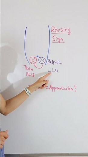 Rovsing Sign #nursingschoolclinicals #anatomyandphysiology #nursingstudent