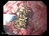 Baloon Dilation Of The Esophagus & Argon Plasma Coagulation Of The Tumor • Video • MEDtube.net
