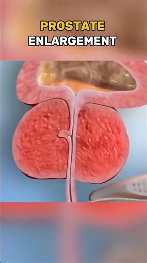 Prostate enlargement surgery 3d animations. Disclaimer: This video is...