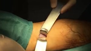 Proximal medial gastrocnemius release ( Popliteal fossa)