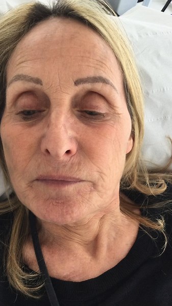 8 months apart. What a difference! Two rounds of mono threads for collagen stimulation and 1 PDO cog face lift. These results are outstanding and proof that PDO threads work. Science works. Great results are from really understanding the science of how PDO threadlifts work. They are not about just the mechanical lift. They are about process, time & biostimulation. #pdothreadqueen ▪️Surrey & Harley St, Londons no1 PDO threads & aesthetics expert ▪️Inventor of the EQlift ▪️Book online at www.EQlib