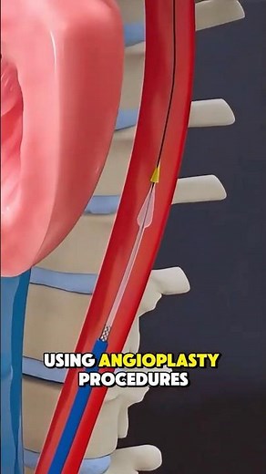 Heart Stent, Aortic Valve Repair with Angioplasty #3danimation #heart #aorticvalve #angioplasty