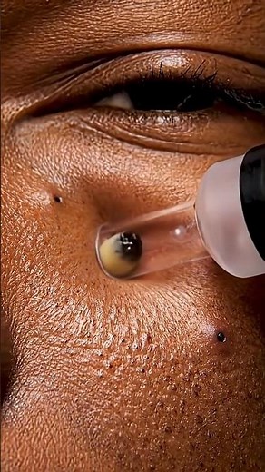 “Extreme Blackheads Extraction – Super Close-Up!”