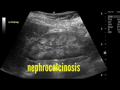 Bilateral nephrocalcinosis ultrasound and color Doppler video