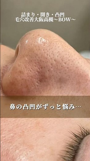 目線が気になる鼻の凸凹には、角栓ケア&プロセルセラピーズ/詰まり・開き・毛穴改善大阪高槻〜BOW〜