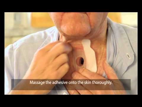 Attaching Provox StabiliBase adhesive