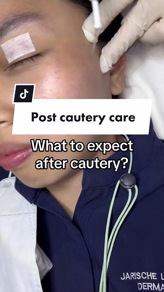 What happens after cautery? #cautery #cauteryprocedure #skincare #skintok #skintokph #thedermamamaph