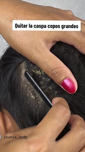 Eliminación efectiva de caspa con ASMR | Dándote alivio y satisfacción