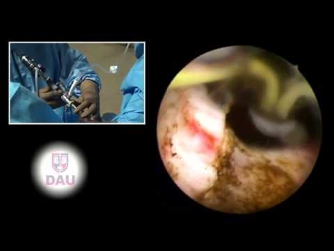 Transurethral Incision of Bladder Neck  • Video • MEDtube.net