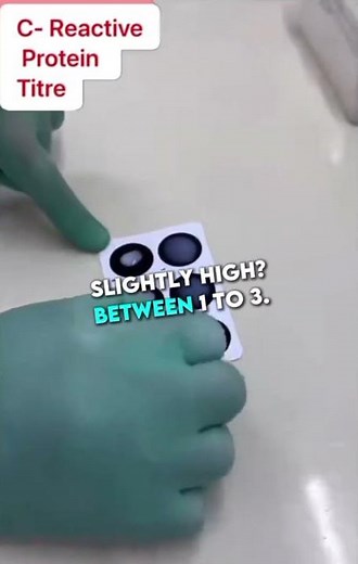 "CRP Blood Test: What It Means & How It’s Done"