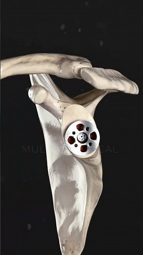 Total Shoulder Arthroplasty for Post-Traumatic Cuff Tear