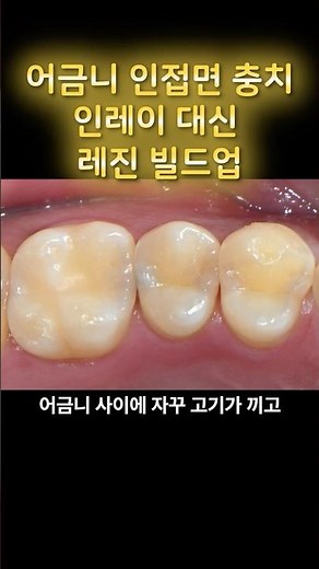 치아 깎아내기 전 꼭 보세요! 어금니 사이 까만 충치, 당일 레진 빌드업으로 해결 #인접면충치 #레진빌드업 #어금니충치