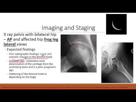 Avascular Necrosis of Femoral Head