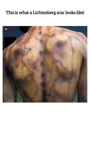 Medessence on Instagram: "A Lichtenberg scar, or Lichtenberg figure, is a temporary, fern-like pattern that appears on the skin after a lightning strike, caused by the electrical current rupturing small blood vessels (capillaries) just under the skin, not by burning. These beautiful, fractal designs, also called "lightning flowers," are temporary, usually fading within 24-48 hours, and serve as a key indicator of a lightning injury, though they are rarely permanent. . Only for education purpose.
