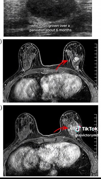 Dealing with a Benign Breast Mass: What You Need to Know