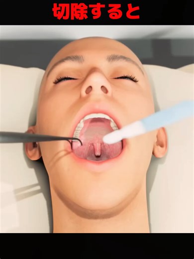 喉の手術と脳の血管破裂の危険性について