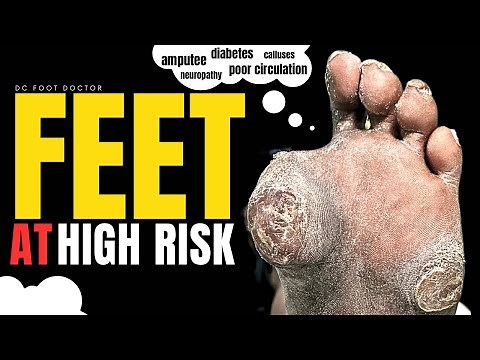 Amputee, Diabetes, Poor Circulation, Neuropathy, and Calluses