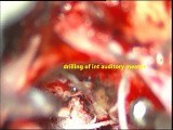 Acoustic Schwannoma -micro surgical excision- Preservation of Facial Nerve • Video • MEDtube.net