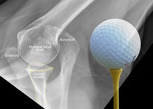 Shoulder Multidirectional Instability (MDI): What is it all about? - Shoulder & Elbow