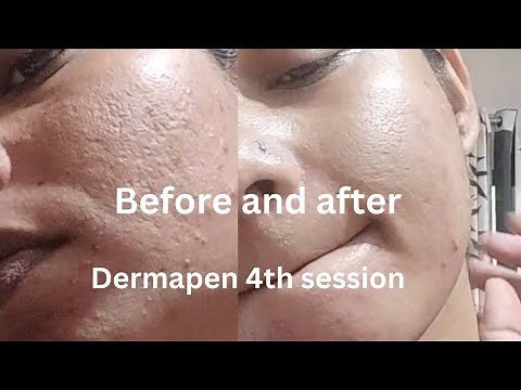 DERMAPEN BEFORE And AFTER RESULTS 💯 genuine review