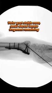 Challenges in Die Punch Distal radius injuries #trauma #ortho #fracture