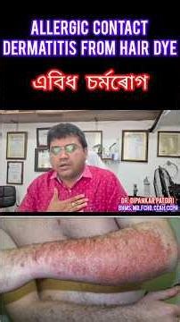Allergic contact dermatitis from hair dye. // এবিধ চৰ্মৰোগ। #patientreview #skincare #skintreatment