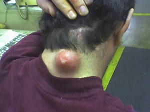 BIGGEST ZIT ON PLANET EARTH!!!!