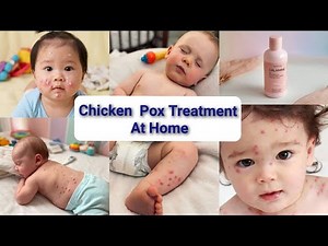 Effective chickenpox treatment At home - What you need to know