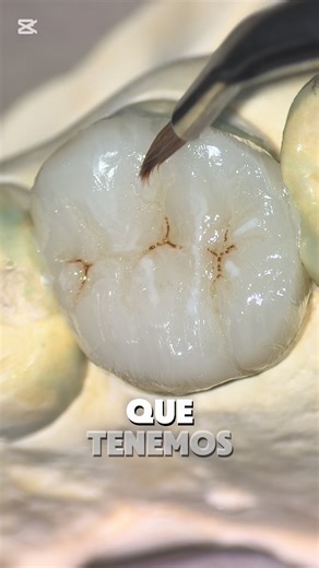 Incrustación de Resina Dental: Proceso y Técnicas