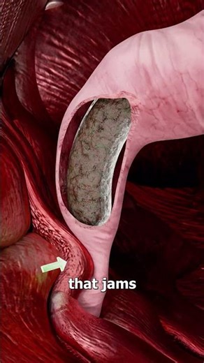 How Squatty Potties Are Better For Pooping 🤔